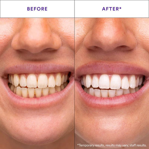 SolvynMT Purple Teeth Whitening Strips